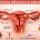 pelvicna inflamatorna bolest